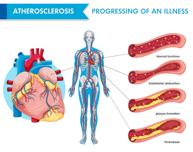 Free Vector | Atherosclerosis progression of an illness