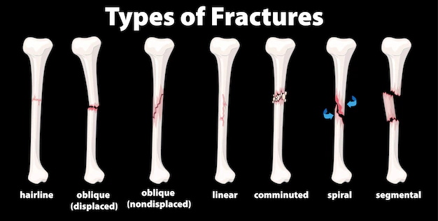 Free Vector | Type of fractures diagram