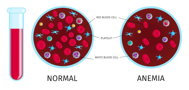 Free Vector | Blood test with anemia infographic