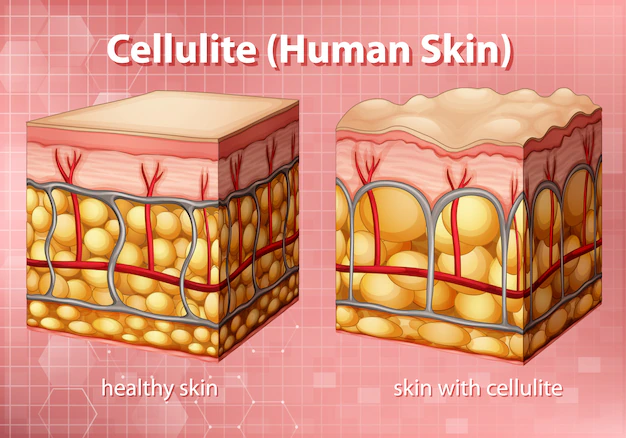Free Vector | Diagram showing cellulite in human skin