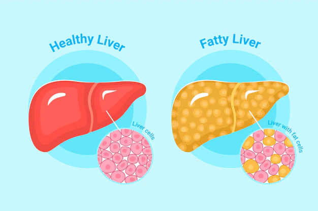 Free Vector | Hand drawn flat design fatty liver illustration