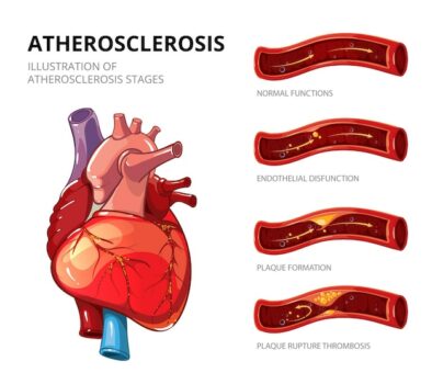 Free Vector | Atherosclerosis. fibrous plaque formation. medical human, health graphic, thrombus in vessel. vector illustration infographic