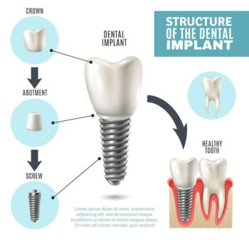 Free Vector | Dental implant structure medical infographic poster