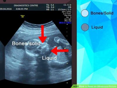 How to Read an Ultrasound Picture 9 Steps with Pictures