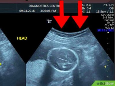 How to Read an Ultrasound Picture 9 Steps with Pictures