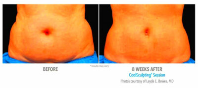 CoolSculpting before and after  Real Patient Photos  Vein  Laser