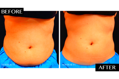 CoolSculpting Ideal Image Stomach Review  NewBeauty