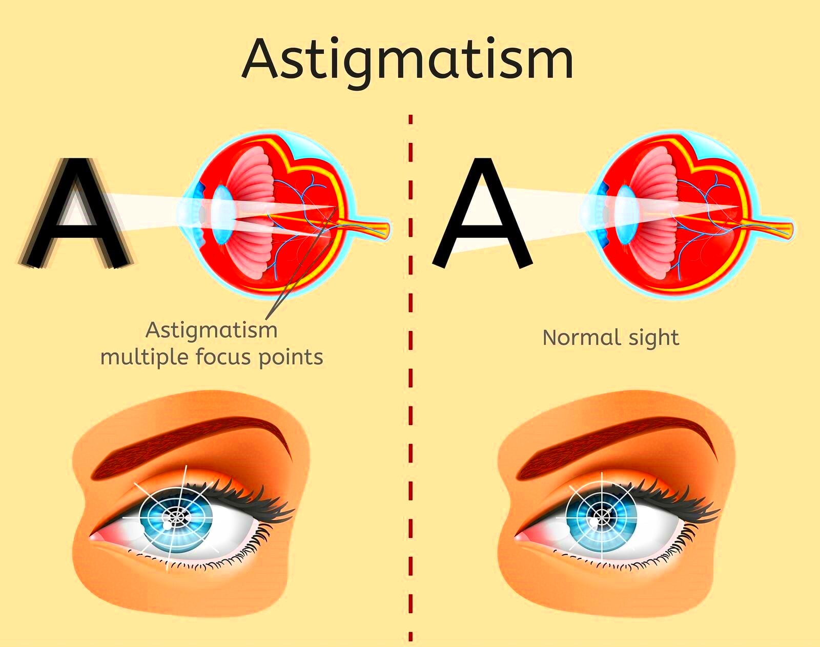 Lasik Eye Surgery Cost for Astigmatism  Excel Eye