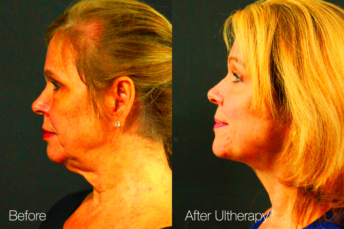 A Complete Guide to Ultherapy Cost and Procedure by Medica Estetica on